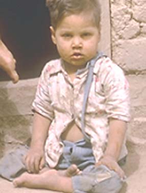 Marcelo, cuando era un niño con las piernas paralizadas por la polio, sentado frente a la cabaña de su familia. El programa de la aldea lo ayudó a caminar, ir a la escuela y luego convertirse en un trabajador de la salud.