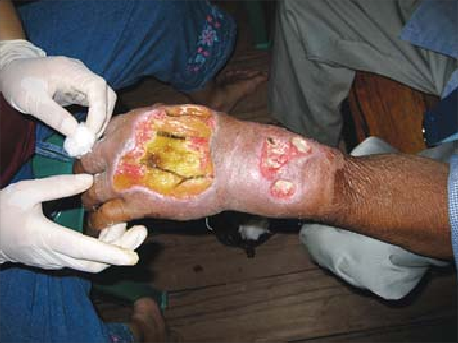 Úlcera diabética severa en la mano de un aldeano.