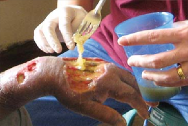 Kinari y Klara aplican una pasta de miel mezclada con azúcar a la úlcera.