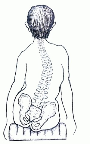 Con su curva espinal, todo el peso de su cuerpo está sobre su isquion derecho (hueso sentado).