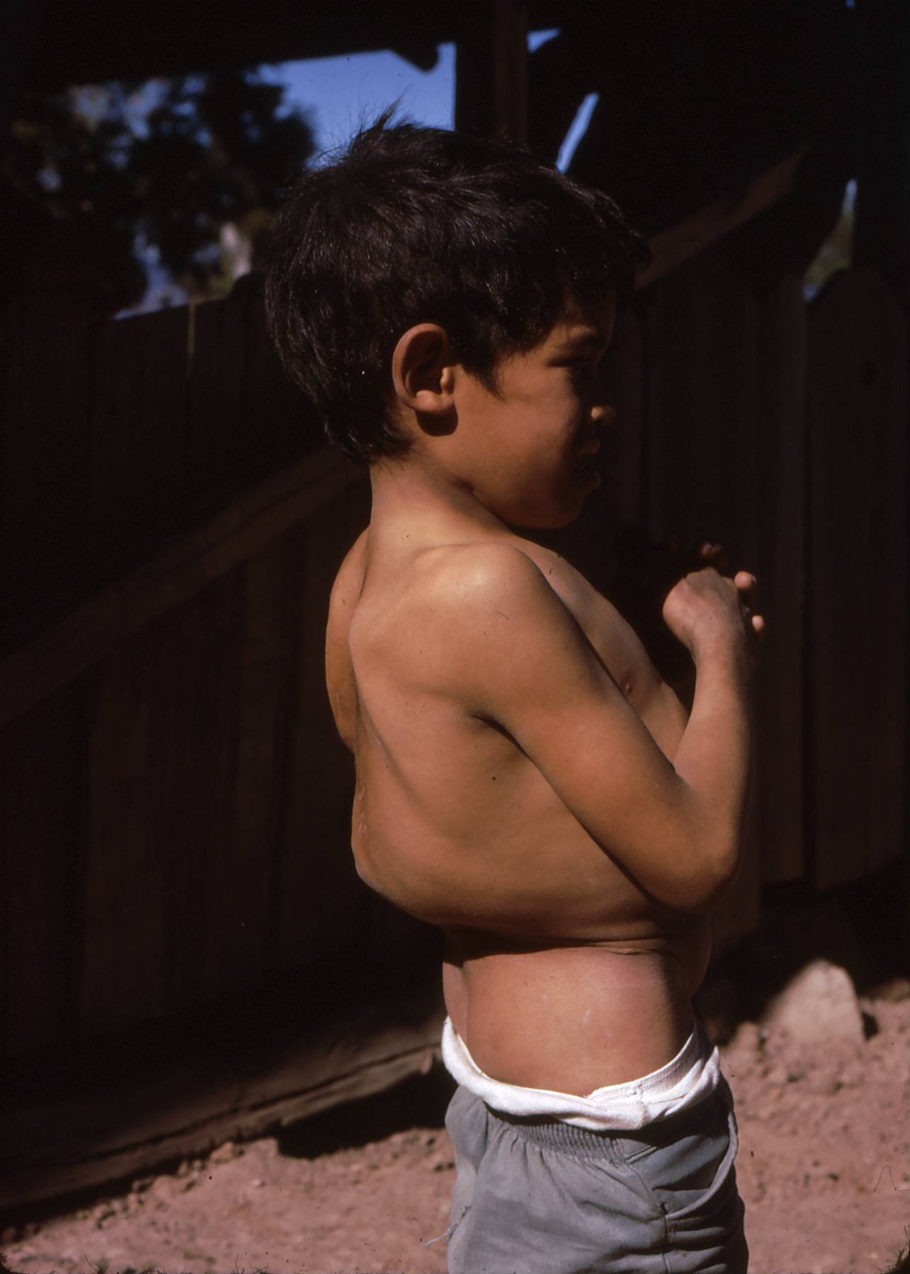 Cuando el Proyecto Piaxtla comenzó en la Sierra Madre, la tuberculosis era una afección común, debilitante y a menudo fatal. Este niño tiene la enfermedad de Pott o tuberculosis de la columna. Gracias al programa de vacunación, la tuberculosis se volvió mucho menos frecuente.