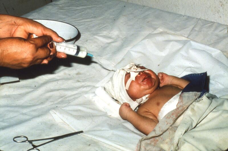 Un bebé con trismo por tétanos (que sobrevivió) es alimentado a través de una sonda nasogástrica. Antes de que las mujeres embarazadas fueran vacunadas contra el tétanos, el tétanos neonatal era una de las principales causas de muerte de los recién nacidos.