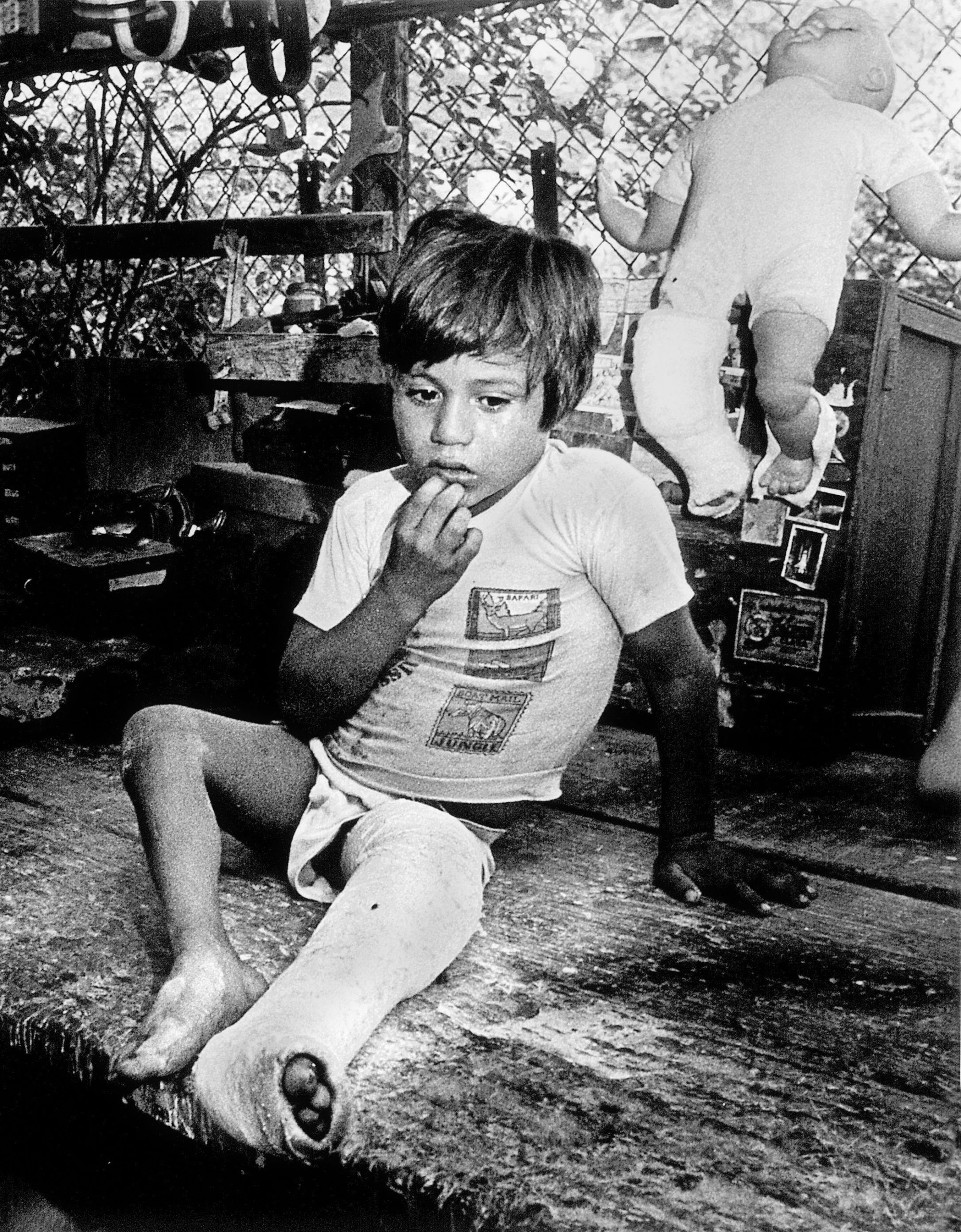 8-year-old Manuelito Jesus' legs were twisted by polio. Here, straightening begins by a series of plaster casts.