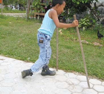 Ocu walked with difficulty with two poles, but his ankles would often flop over to the outside, causing him to stumble and sometimes fall.