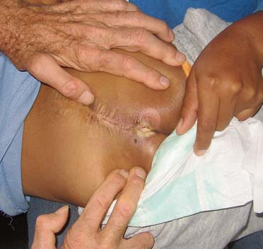 Persons with spinal cord injury (including spina bifida) risk getting pressure sores because of reduced feeling below the level of the injury. Oddly, however, Domingo’s sore was over the base of his spine. Midline sores (blue arrows) like this mostly occur only in persons confined to bed.