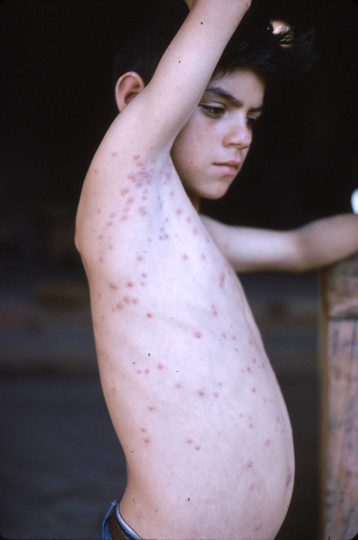 Measles was epidemic in the Sierra Madre before vaccination.